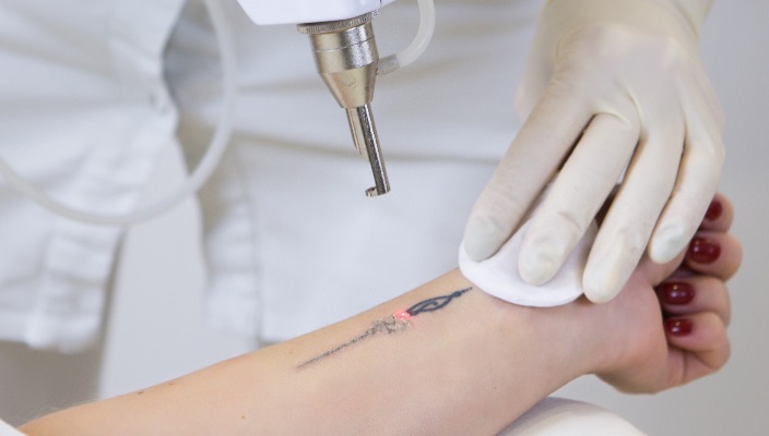 Tattoo-Removal-inline