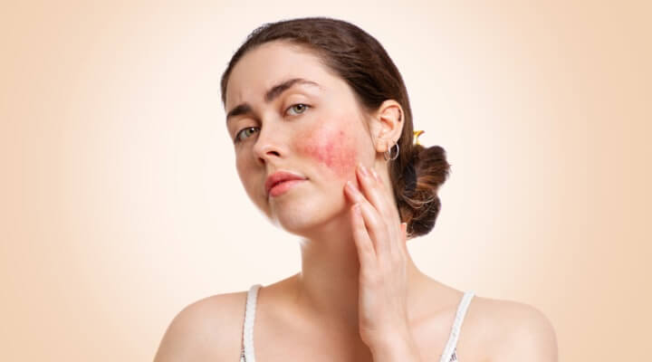 Rosacea-Triggers-Header-Thumbnail