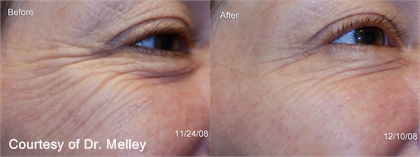 BOTOX® and Dysport® Before and After