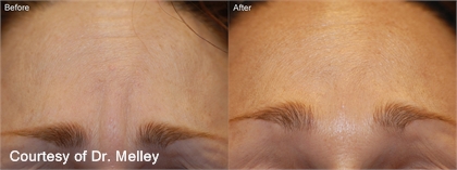 Fine Lines and Wrinkles Before and After