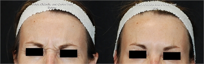 BOTOX® and Dysport® Before and After