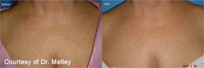 Cynosure Apogee Elite Laser Before and After