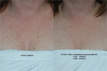 Age Spots and Sun Damage Before and After