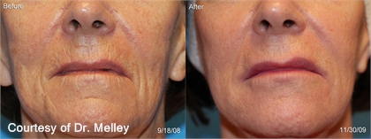 Skin Laxity Before and After