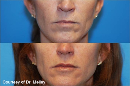 Juvederm and Restylane Before and After