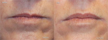 Juvederm and Restylane Before and After