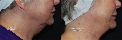Kybella® Before and After