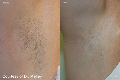 Unwanted Hair Before and After