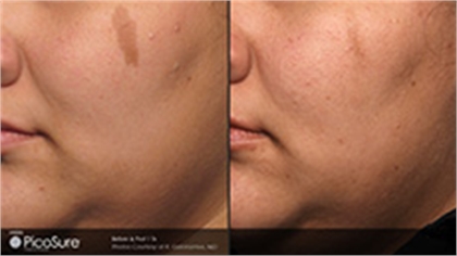 Age Spots and Sun Damage Before and After