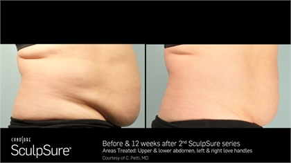 SculpSure Before and After