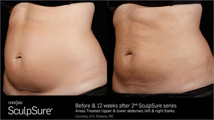 Stubborn Fat Before and After