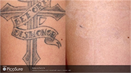 PicoSure, Tattoo Removal, Cynosure, Laser
