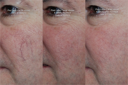 Facial Vessels Before and After