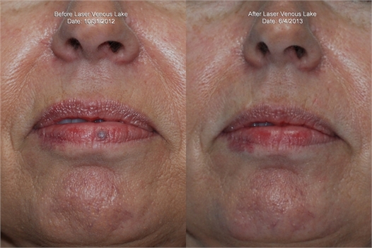 Benign Skin Lesions Before and After
