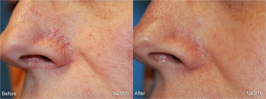 Facial Vessels Before and After